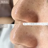 【毛穴ケア・詰まり解消】全顔ハイドロ毛穴洗浄+パック+選べる毛穴洗浄ヘッドorドライヘッドケア💆‍♀️50min✨️