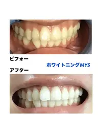 【初めての方限定✨】即実感！話題のセルフホワイトニング15分×２回照射を1,650円で！