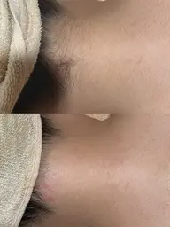 【後ろ姿ケア】うなじ+背中ワックス脱毛