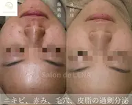✨🌿ミニモ学割🌿✨💎人気No.1 肌質改善‼️剥離有りハーブピーリング💎