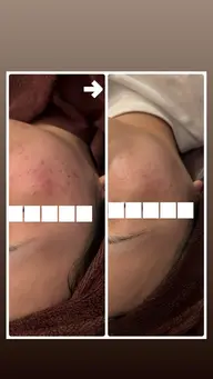 🌿‬【本気でお肌に悩んでる方へ✨️】話題のハーブピーリング＋角質ケアor毛穴洗浄 90分 カウンセリング付き