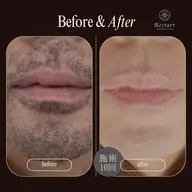 顔脱毛