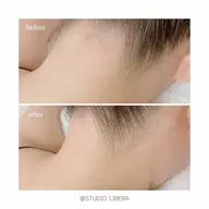 【初回限定】 全身脱毛コース(顔 VIO込)