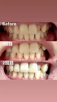 セルフホワイトニング