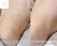 自信が持てる背中ケア《先着5名様ミニモ限定》最高品質剥けるハーブピーリング×鎮静ケア《体用》