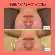 【ミニモ学割👧🏻U24】むくみ・ふっくら感解消で垢抜け印象へ❣️透明感小顔フェイシャル💎✨(ハイパーナイフEX)