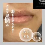 🚺限定❗️脱毛士による丁寧な顔脱毛🥼他店で抜けなかった方、初めてで分からない方、丁寧なカウンセリング込みです🤓