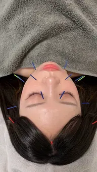 美容鍼