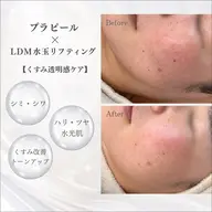 《透明感水光肌✨》プラピール+LDM水玉リフティング+プラズマニードル 【 保湿/くすみ/美白/シミ/肝斑ケア 】