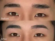 ワックス脱毛