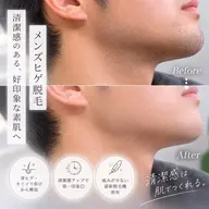 メンズ ひげ脱毛(全体)