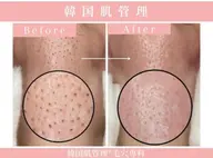 🌱【今月・ご新規様限定】🕊️毛穴洗浄×ヒト幹細胞美容液×モデリングパック｜水光ツヤ肌