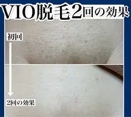 VIO脱毛