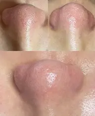 結果が目にみえる👀👃毛穴に悩むあなたへ届けたい。毛穴ケア特別体験価格