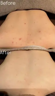 背中フォト/光フォトで背中の吹き出物や毛穴を改善します！