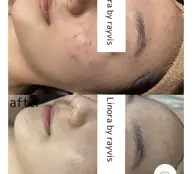 25歳以上限定クーポン😲毛穴レス陶器肌✨全顔シェービング付きＩＰＬ脱毛✨ツヤ爆誕✨メイクノリUP💕