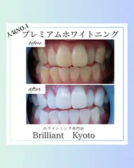 【ミニモ限定クーポン】医療プレミアムホワイトニング / 本来の歯よりも白くなりたい方に🦷✨