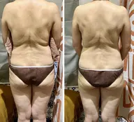 キャビテーションダイエットモニター2パーツ