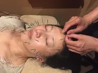 美顔鍼 40本 ✕ PNFプライム 〈お顔のたるみに💕〉