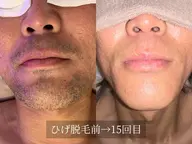 【男性】ひげ脱毛(目の下​〜​首)照射後ケア込
