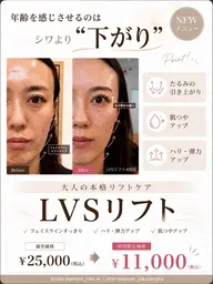 【たるみ・肌質改善】切らないリフトアップ「LVSリフト」60分