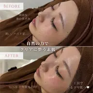 【人気SET✨】CHRISTINAハーブピーリング＋美容液導入｜毛穴・ニキビケア