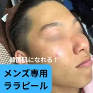 【男性専用 韓国肌ララピール】SNSで大人気!第4世代ピーリング毛穴/美白/ニキビ/ニキビ痕‥◎完全個室なのも◎男性3割
