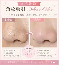 💎人気No.1💎【毛穴洗浄】黒ずみ・角栓吸引✕美肌シェービング💕