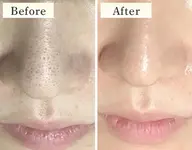 【いちご鼻必見🍓】皮脂・角質に特化した毛穴ケア✨詰まりをスッキリさせたい方におすすめ💆♀️