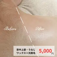 背中上部・うなじWAX+光脱毛 ¥5,000