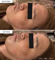 【メンズメニュー】ピーリングでニキビ・ごわつき改善🧖♂️皮向け・赤みなし✨エステ初心者さんも経験者さんも変化実感◎