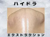 ハイドラ×毛穴エクストラクション★水光肌リフティング付き