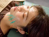 美容鍼