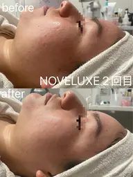AI機能搭載フェイシャル機器「NOVELUXE」 初回お試し