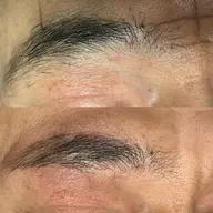 脱毛