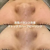 ハーブピーリング|ニキビ・毛穴特化ケア
