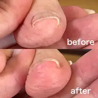 【巻き爪アクリル補正】オフありご新規様✨他店オフ無理＆丁寧の甘皮ケア込み