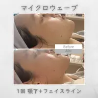 本日限定‼️【二重顎・たるみ】オ○ダリフト 150kj 顎下+フェイスライン