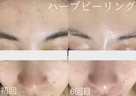 【夏限定】毛穴・皮脂すっきりハーブピーリング !