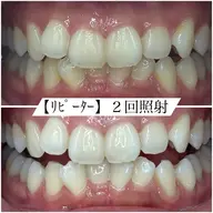 【リピーター】ホワイトニング　2回照射　15分×1回、5分×1回