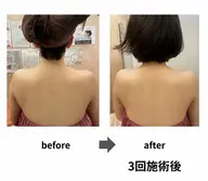 脱・巻肩、ボッコリ肩、ショックプレスで華奢な上半身へ