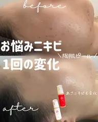 お肌の磨きあげ♡REVIナノバブルピール🫧
