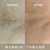 顔・VIO込み全身脱毛