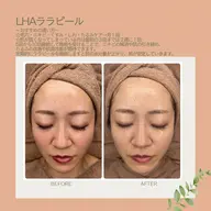 内側から肌を育てるピーリング🌷LHAララピール💚毛穴/ニキビ/くすみ/たるみ/エイジングケア/肌質改善