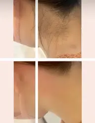 男女人気！うなじ脱毛
