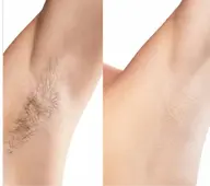 痛くない🉐両脇脱毛