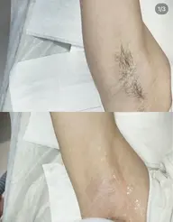 両脇脱毛
