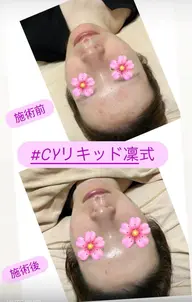 剥離なしハーブピーリング