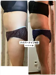 ✨大人気No.1✨🔥新型ハイパーナイフ6(下半身)+インド瘦身+ヘッドスパ60分7900