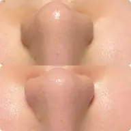 ⭐️毛穴エクストラクションのモデル募集⭐️